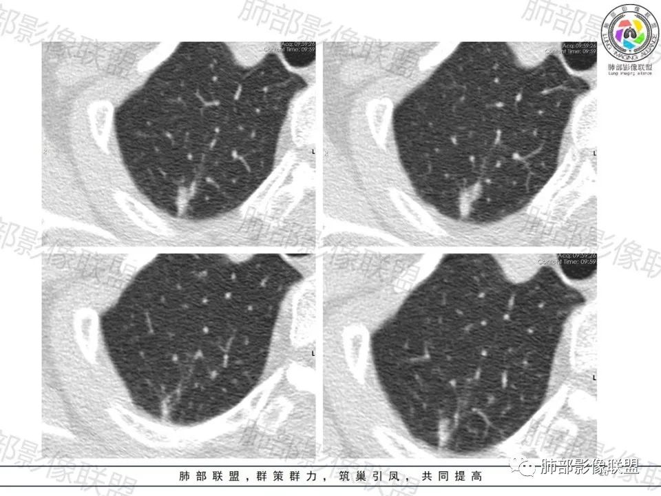 影像PPT - 【病例】一眼望穿的肺阴影—浸润性肺腺癌-17 影像PPT - 【病例】一眼望穿的肺阴影—浸润性肺腺癌-17