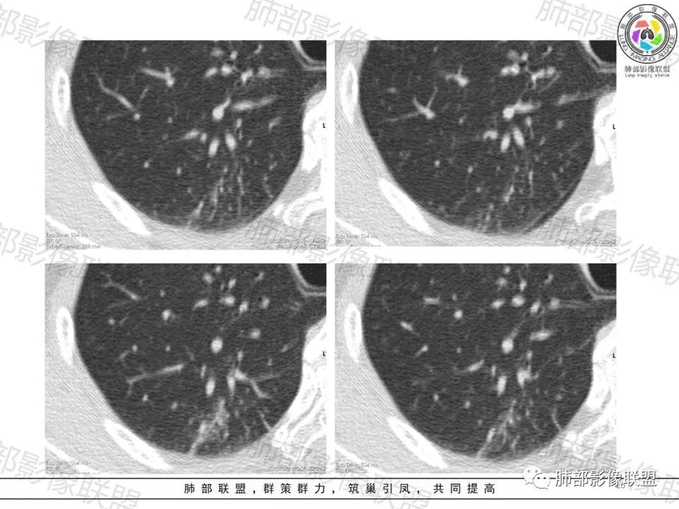 影像PPT - 【病例】一眼望穿的肺阴影—浸润性肺腺癌-20 影像PPT - 【病例】一眼望穿的肺阴影—浸润性肺腺癌-20