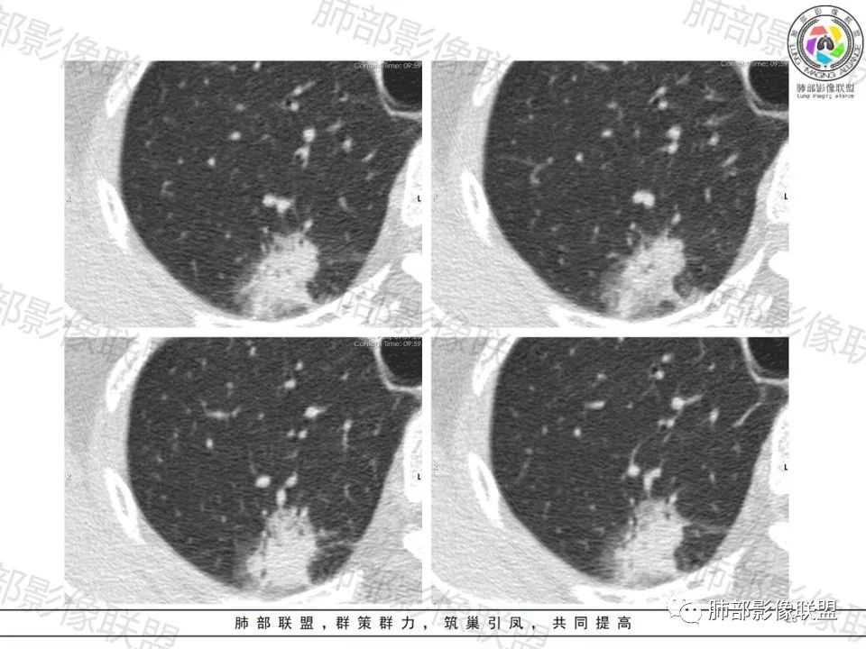 影像PPT - 【病例】一眼望穿的肺阴影—浸润性肺腺癌-19 影像PPT - 【病例】一眼望穿的肺阴影—浸润性肺腺癌-19