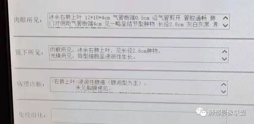 影像PPT - 【病例】一眼望穿的肺阴影—浸润性肺腺癌-23 影像PPT - 【病例】一眼望穿的肺阴影—浸润性肺腺癌-23