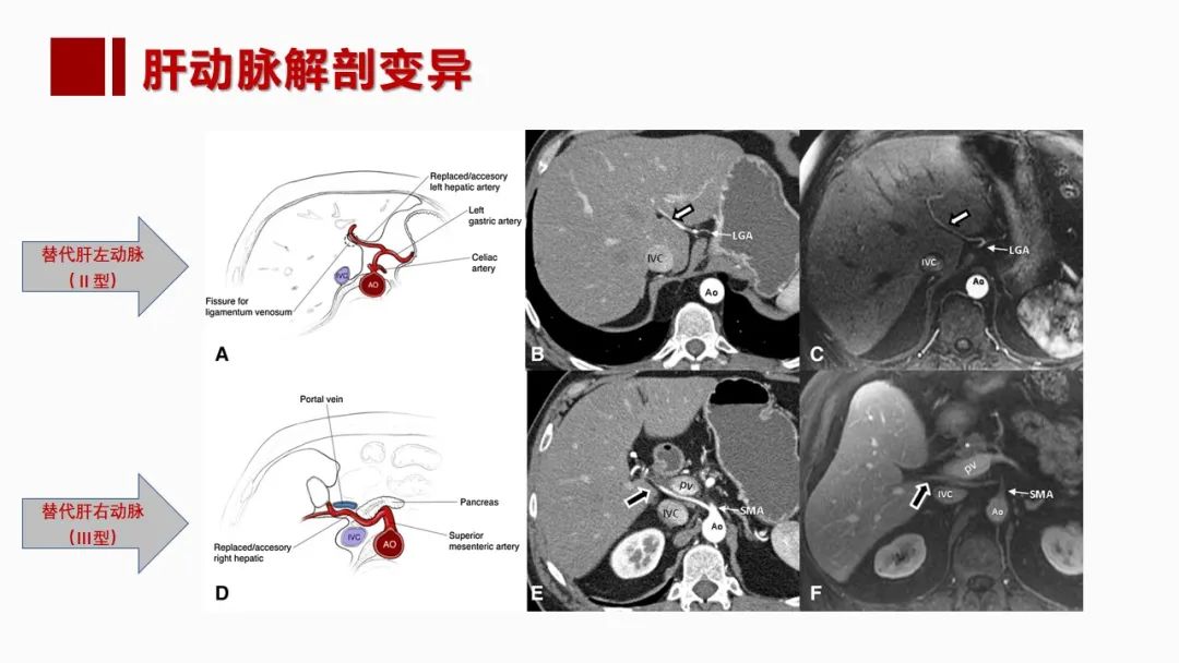影像PPT - 【PPT】肝脏管道系统解剖变异影像评价-11
