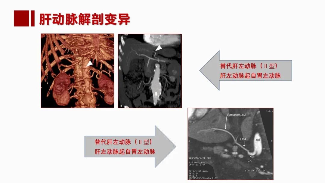 影像PPT - 【PPT】肝脏管道系统解剖变异影像评价-12