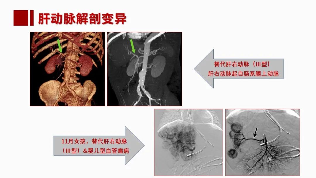 影像PPT - 【PPT】肝脏管道系统解剖变异影像评价-13