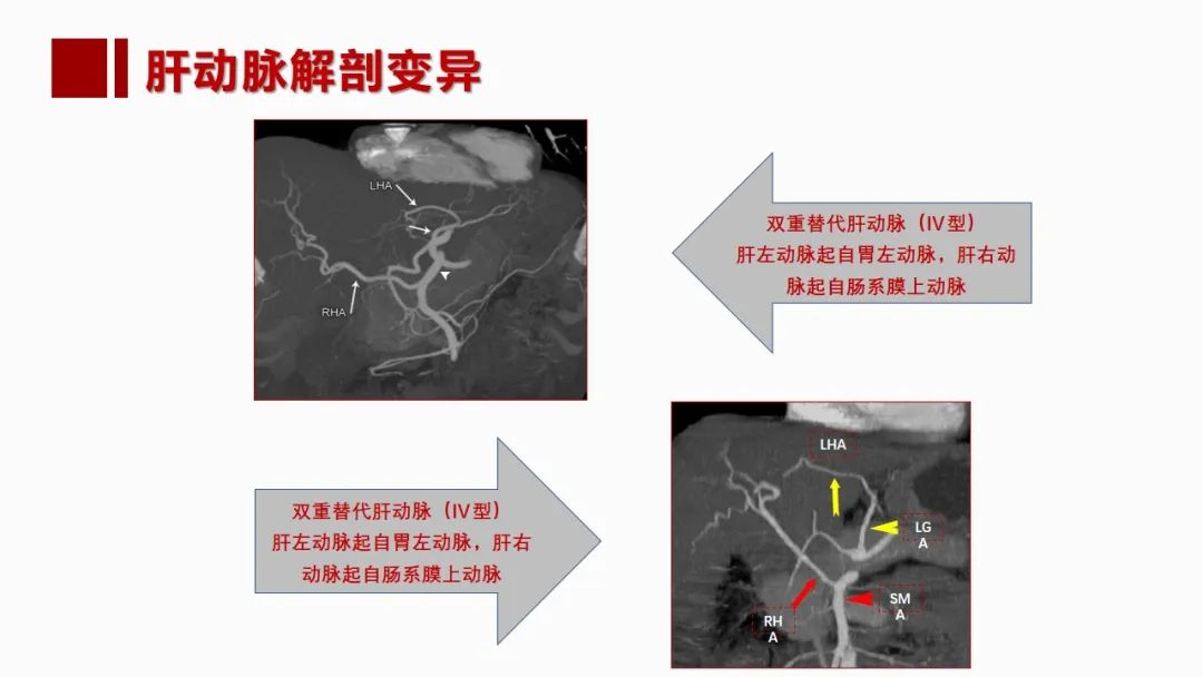 影像PPT - 【PPT】肝脏管道系统解剖变异影像评价-14