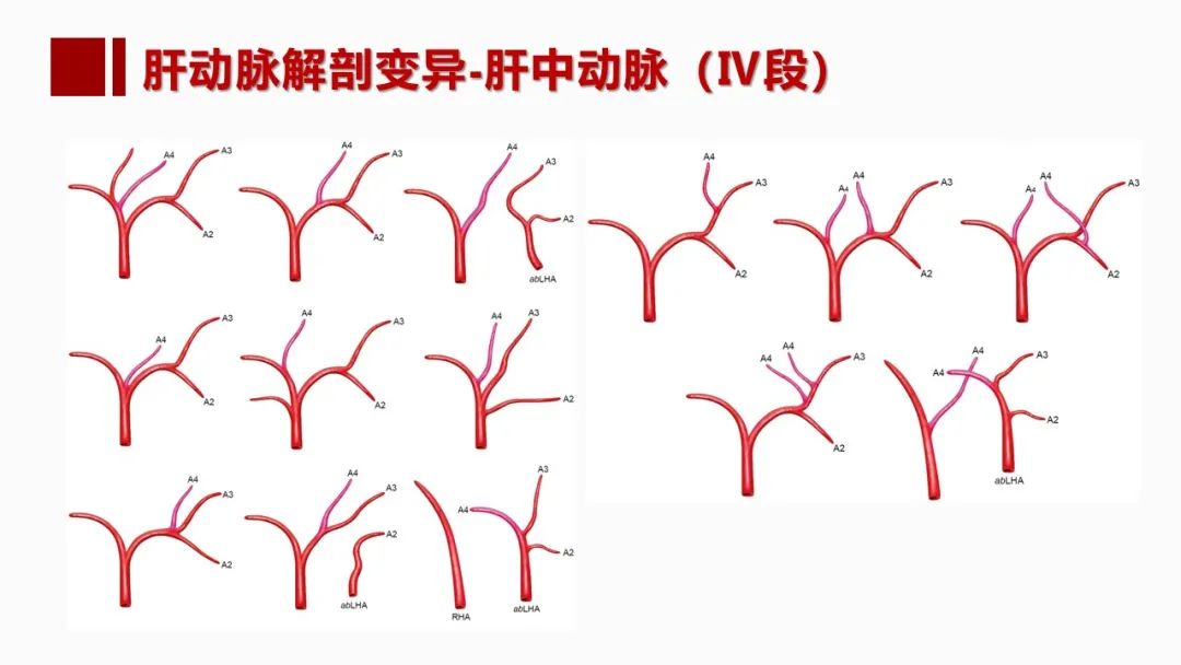 影像PPT - 【PPT】肝脏管道系统解剖变异影像评价-16