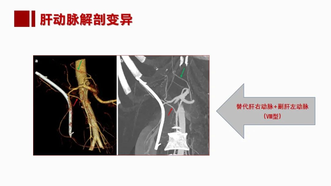 影像PPT - 【PPT】肝脏管道系统解剖变异影像评价-15