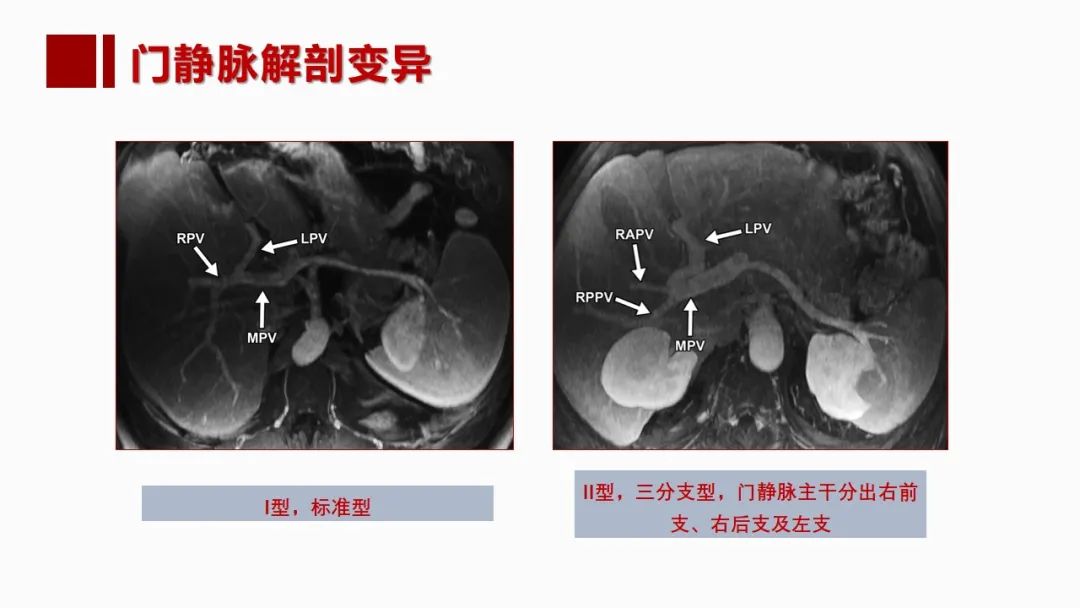 影像PPT - 【PPT】肝脏管道系统解剖变异影像评价-24