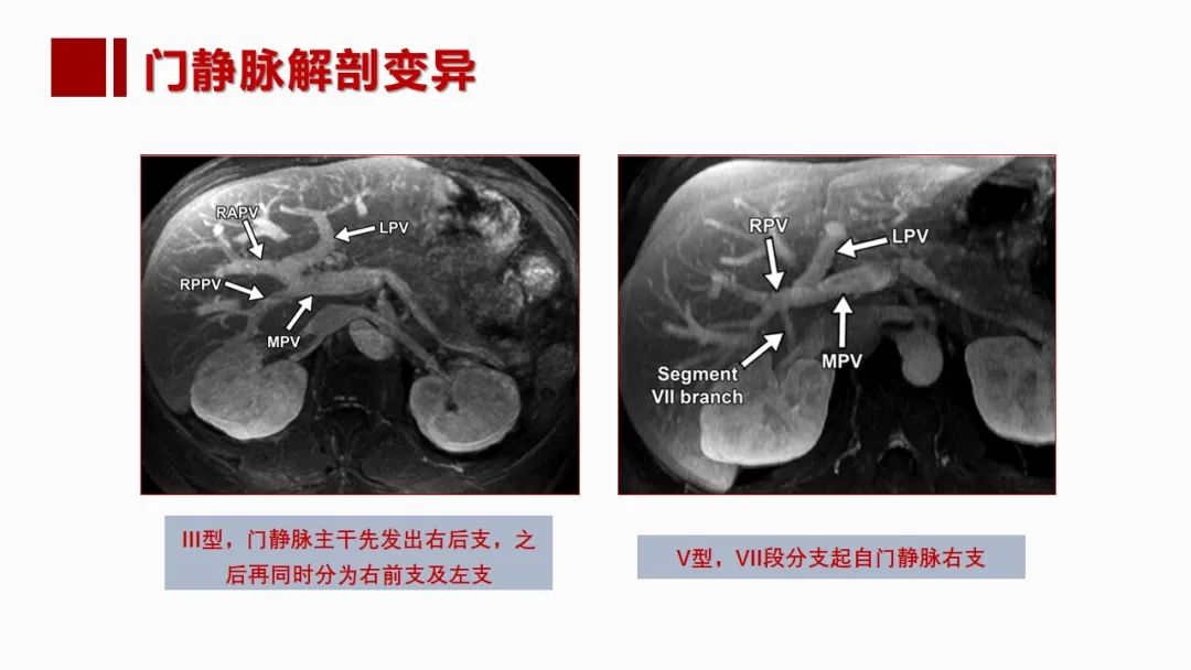 影像PPT - 【PPT】肝脏管道系统解剖变异影像评价-25