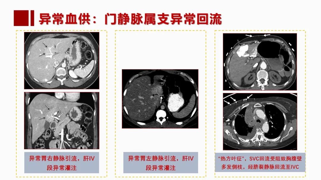 影像PPT - 【PPT】肝脏管道系统解剖变异影像评价-27