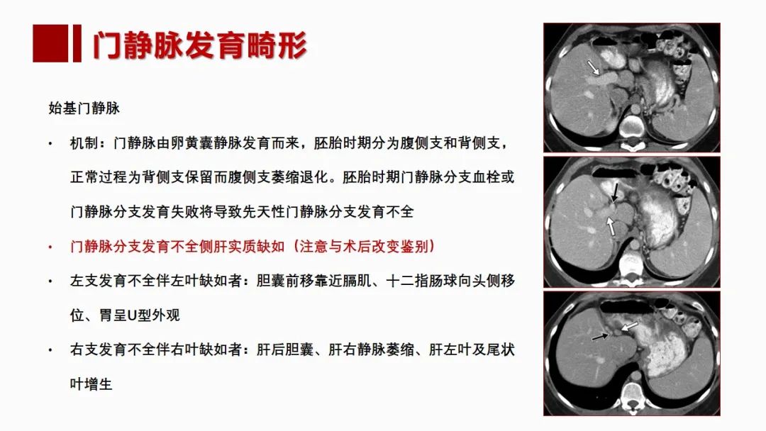 影像PPT - 【PPT】肝脏管道系统解剖变异影像评价-29