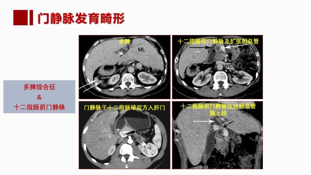 影像PPT - 【PPT】肝脏管道系统解剖变异影像评价-31