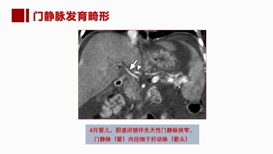 影像PPT - 【PPT】肝脏管道系统解剖变异影像评价-33
