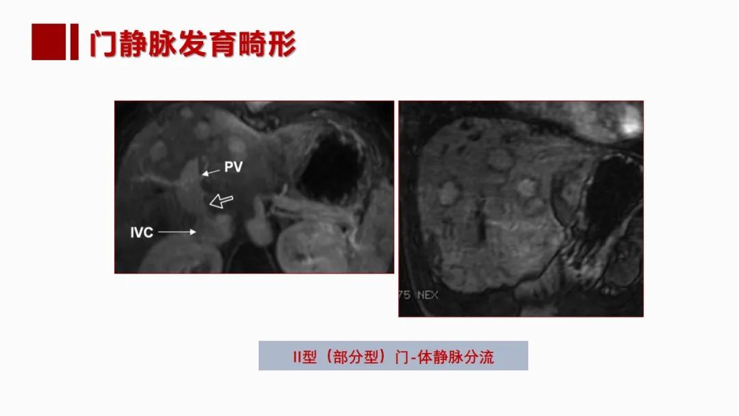 影像PPT - 【PPT】肝脏管道系统解剖变异影像评价-35