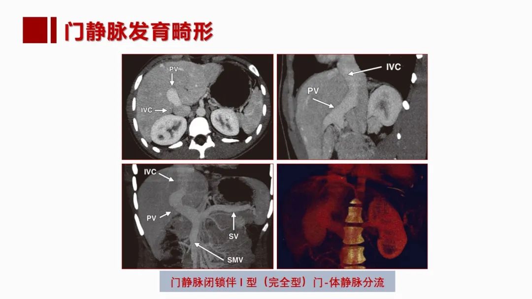 影像PPT - 【PPT】肝脏管道系统解剖变异影像评价-34