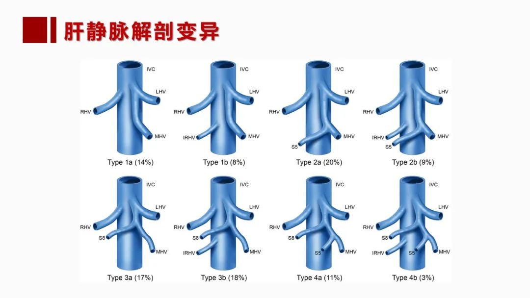 影像PPT - 【PPT】肝脏管道系统解剖变异影像评价-38