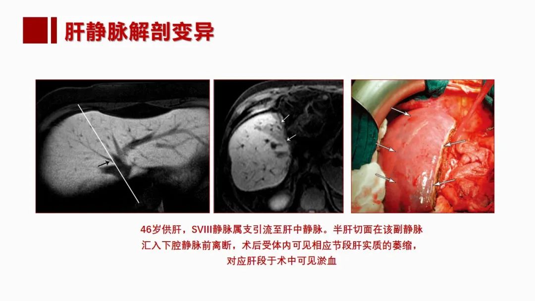 影像PPT - 【PPT】肝脏管道系统解剖变异影像评价-40
