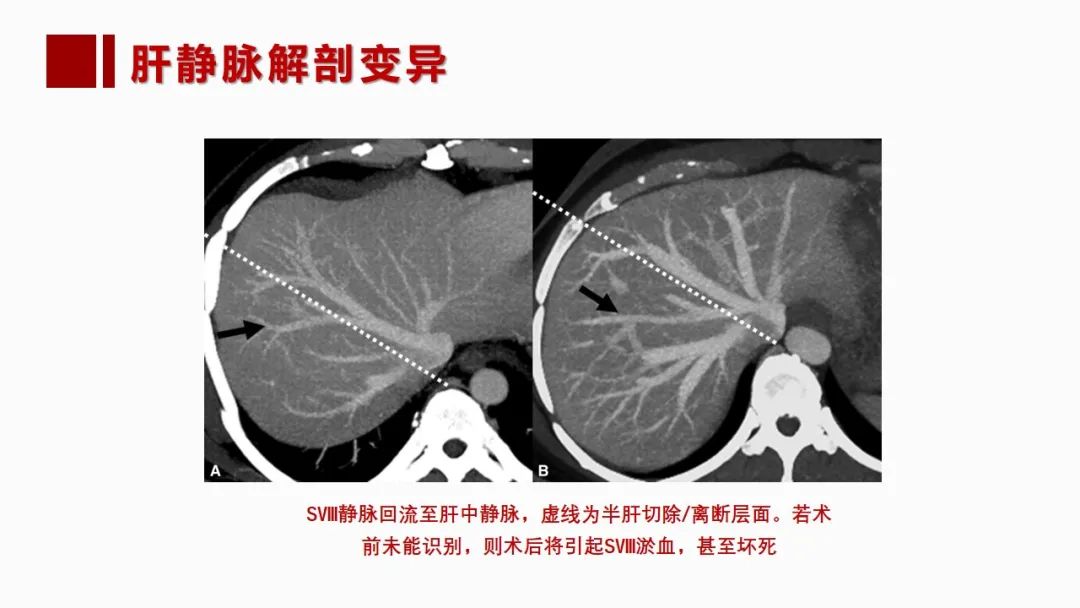 影像PPT - 【PPT】肝脏管道系统解剖变异影像评价-39