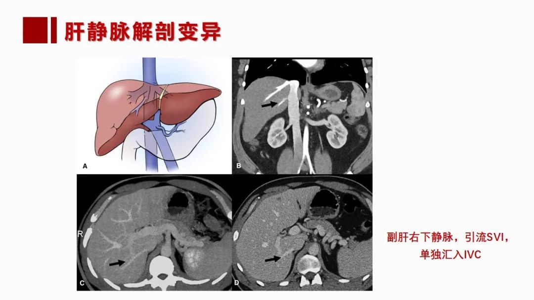 影像PPT - 【PPT】肝脏管道系统解剖变异影像评价-41