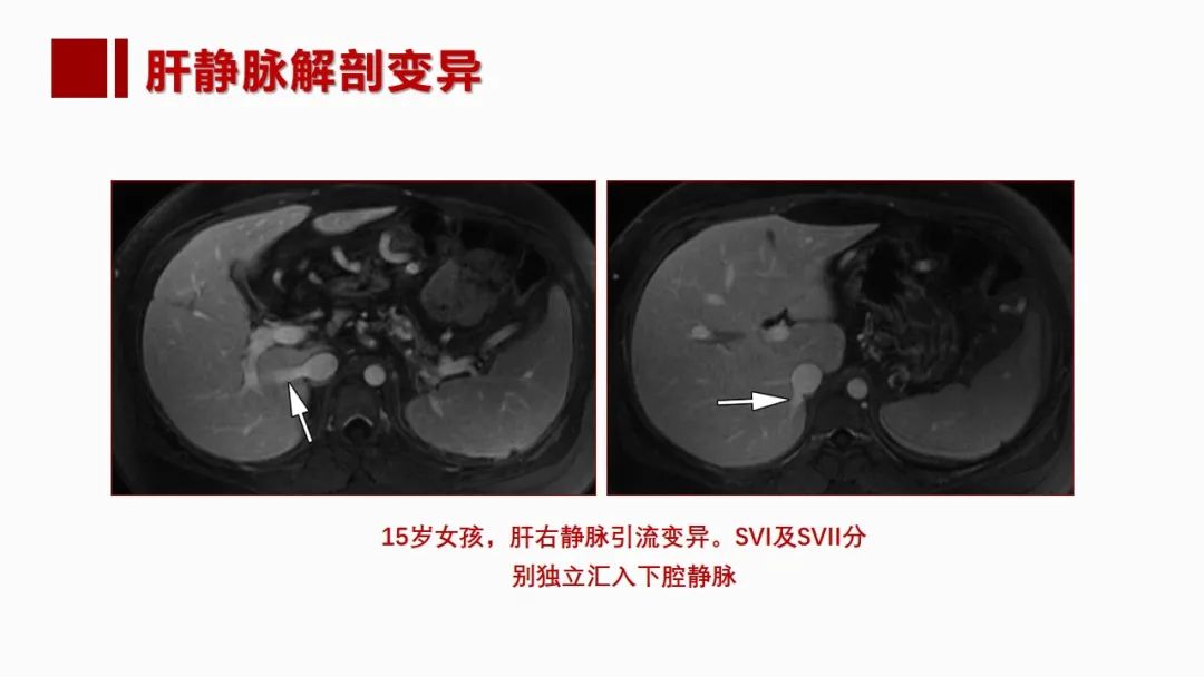影像PPT - 【PPT】肝脏管道系统解剖变异影像评价-42