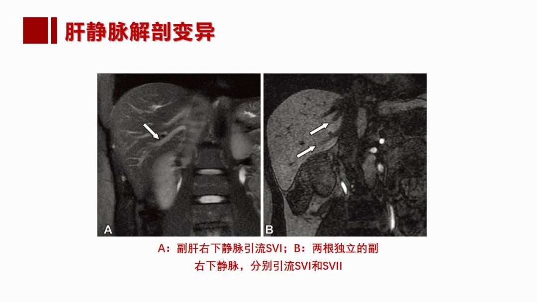 影像PPT - 【PPT】肝脏管道系统解剖变异影像评价-43