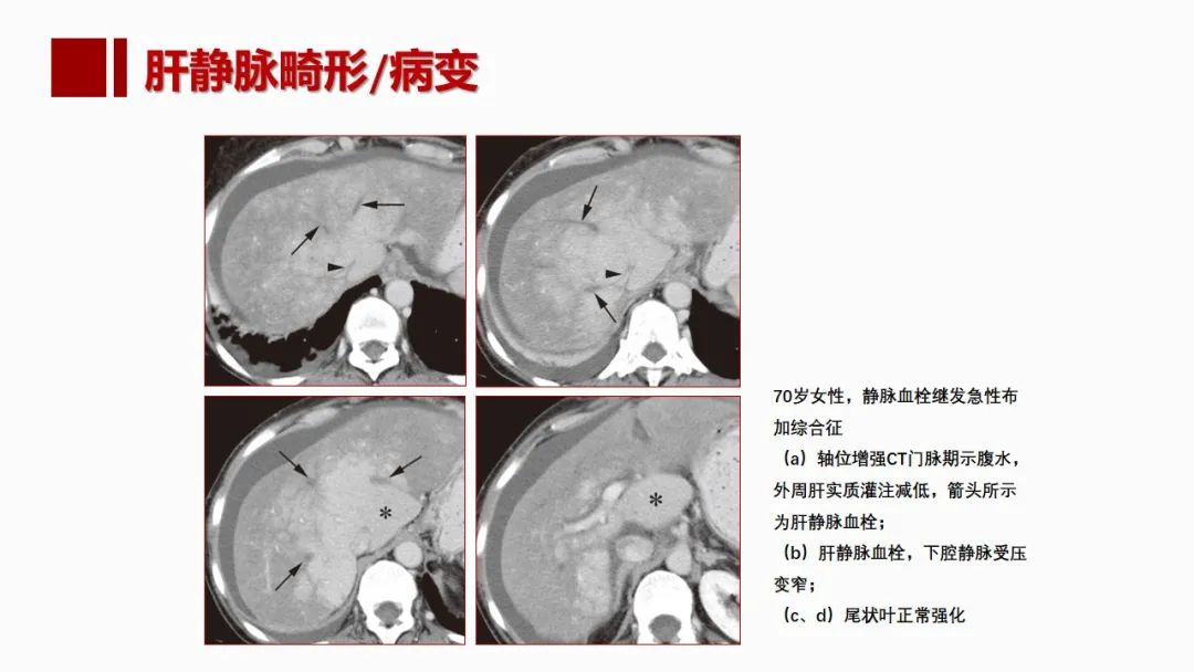 影像PPT - 【PPT】肝脏管道系统解剖变异影像评价-47