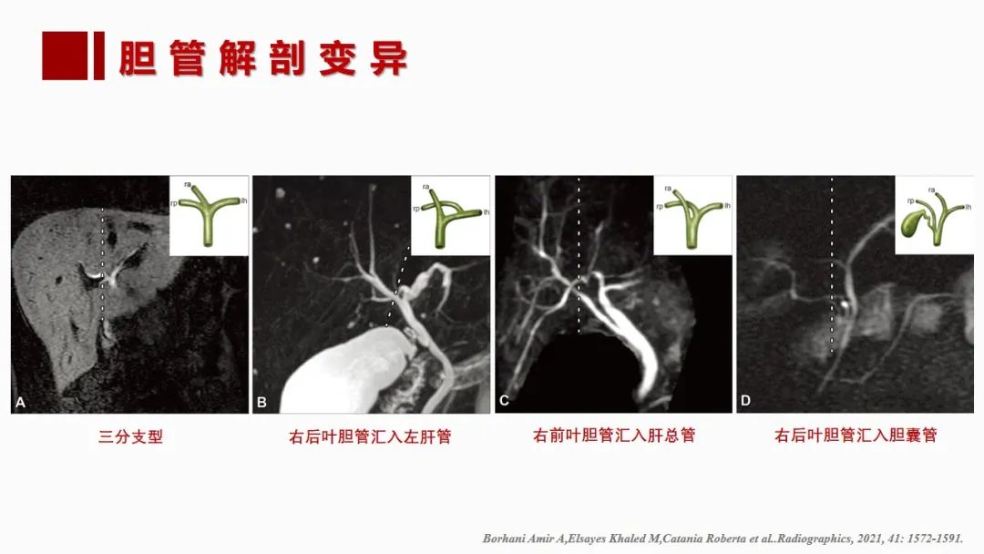 影像PPT - 【PPT】肝脏管道系统解剖变异影像评价-50