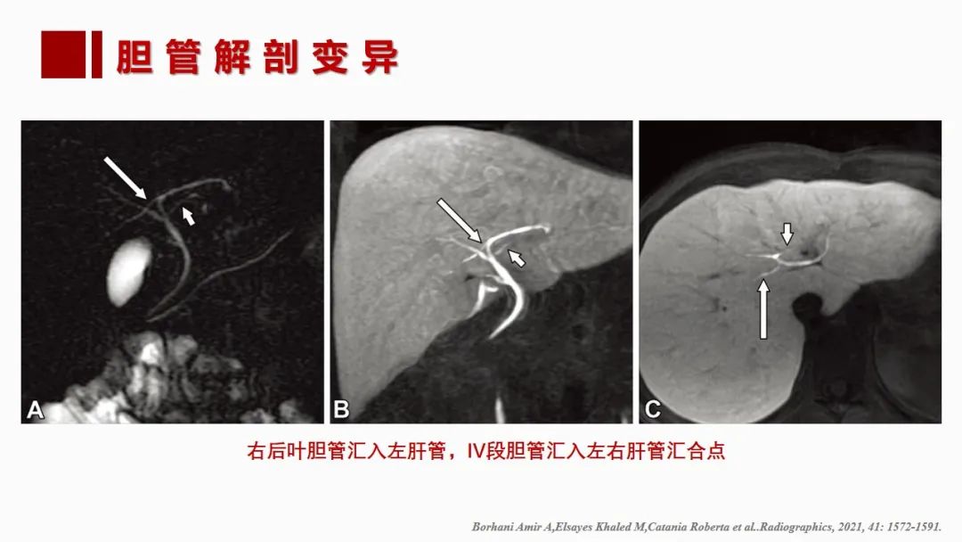 影像PPT - 【PPT】肝脏管道系统解剖变异影像评价-51