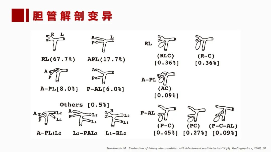 影像PPT - 【PPT】肝脏管道系统解剖变异影像评价-52