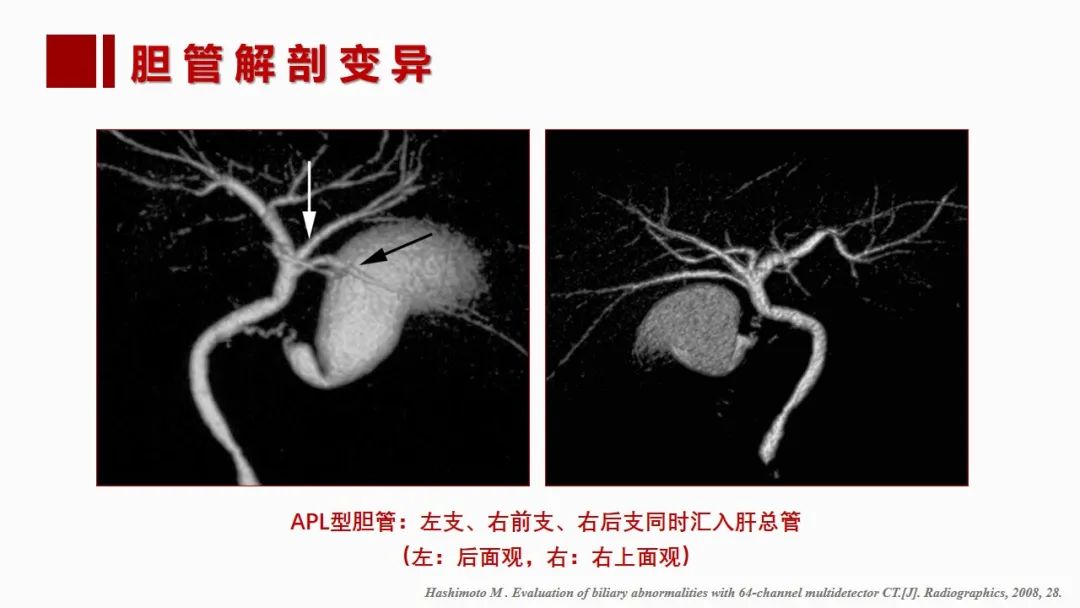 影像PPT - 【PPT】肝脏管道系统解剖变异影像评价-53