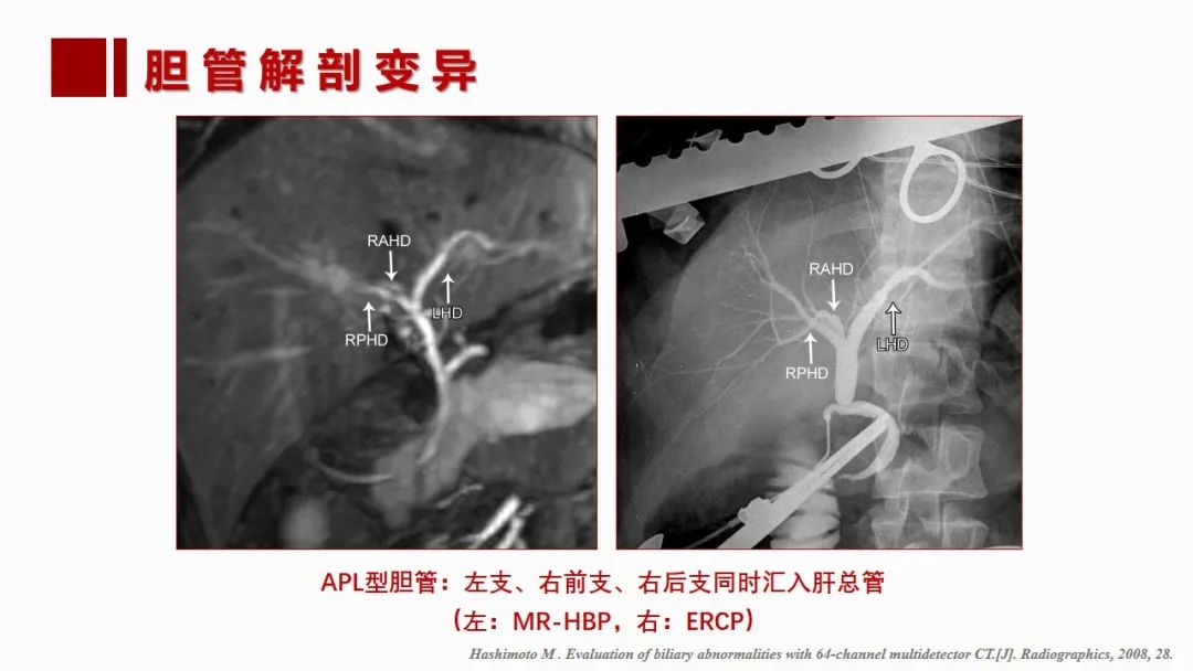 影像PPT - 【PPT】肝脏管道系统解剖变异影像评价-54