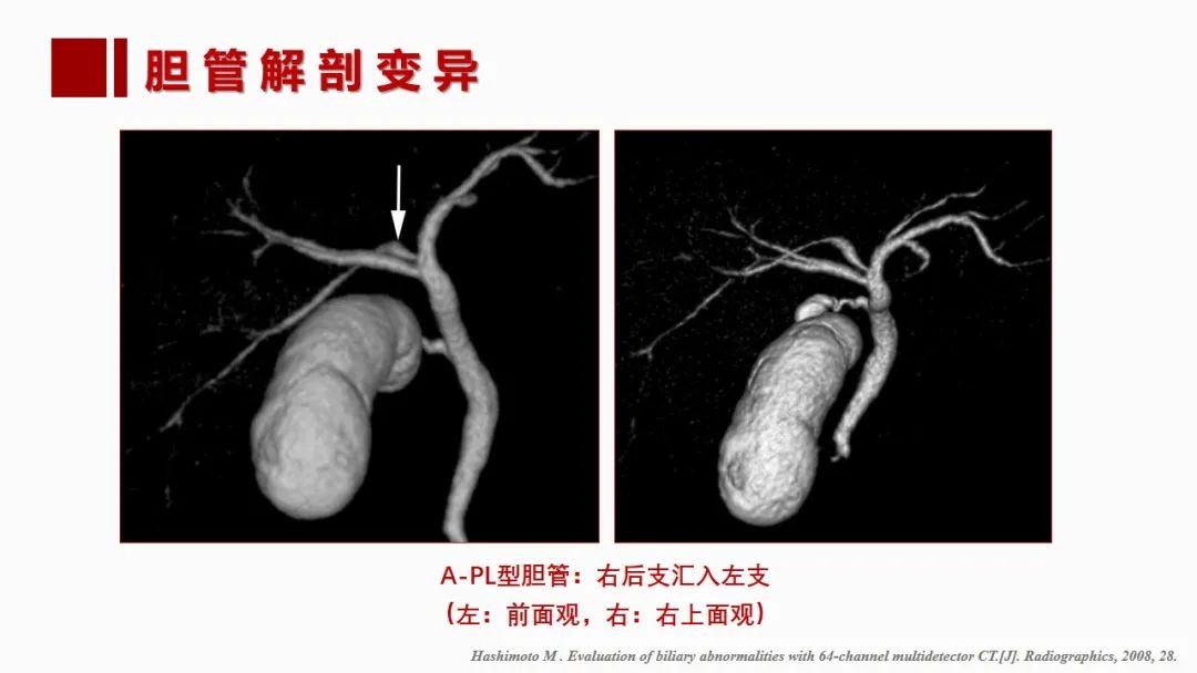 影像PPT - 【PPT】肝脏管道系统解剖变异影像评价-55