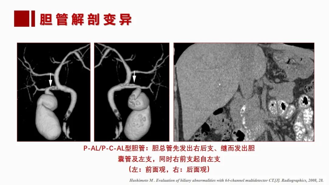 影像PPT - 【PPT】肝脏管道系统解剖变异影像评价-56