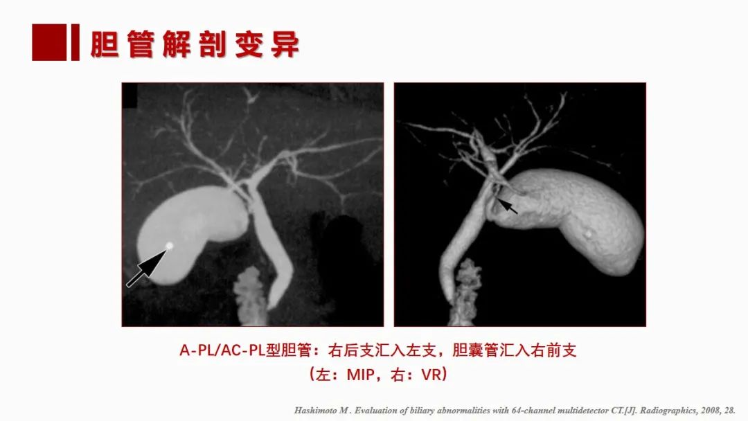 影像PPT - 【PPT】肝脏管道系统解剖变异影像评价-57