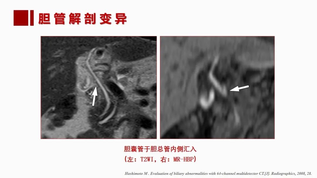 影像PPT - 【PPT】肝脏管道系统解剖变异影像评价-58