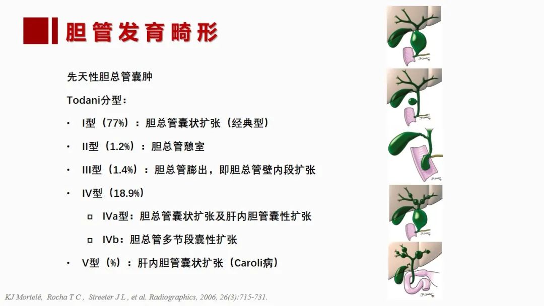 影像PPT - 【PPT】肝脏管道系统解剖变异影像评价-60