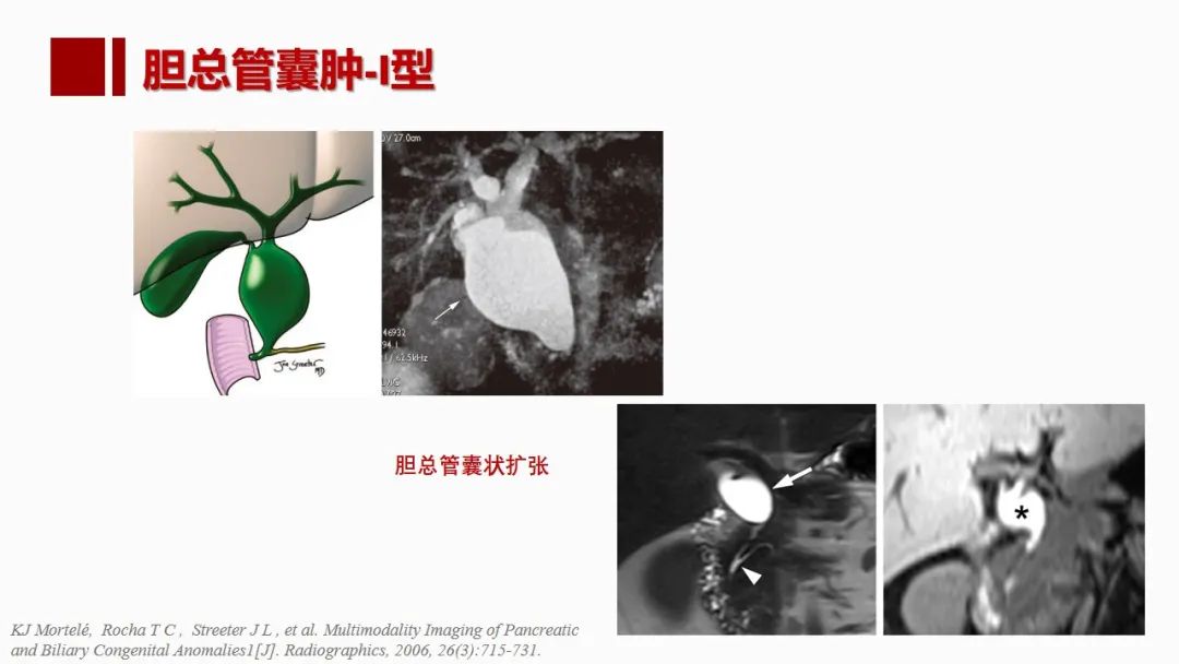 影像PPT - 【PPT】肝脏管道系统解剖变异影像评价-61