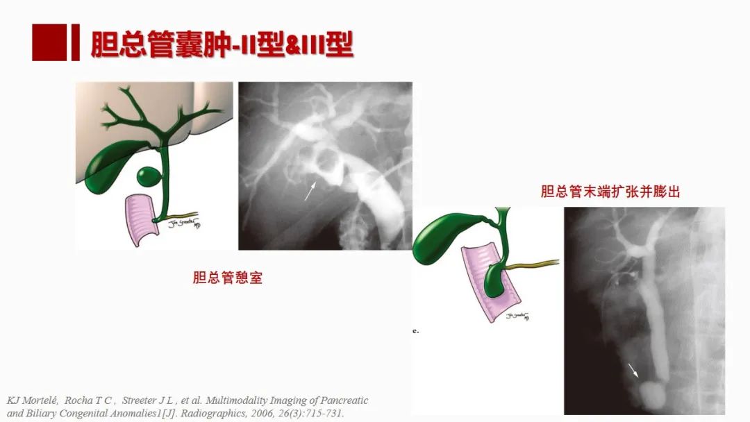 影像PPT - 【PPT】肝脏管道系统解剖变异影像评价-62