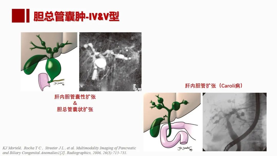影像PPT - 【PPT】肝脏管道系统解剖变异影像评价-63