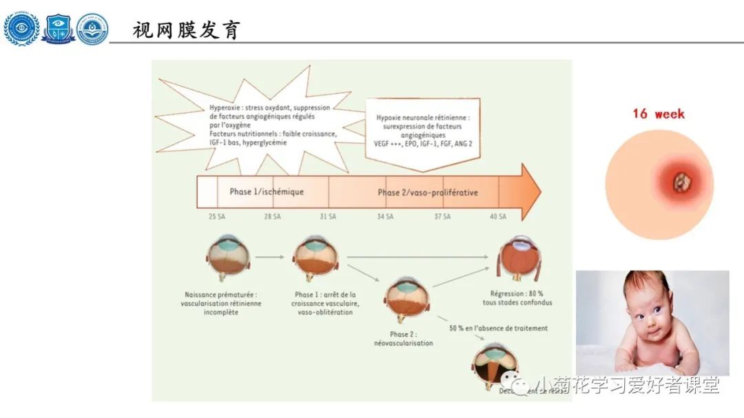 影像PPT - 【PPT】早产儿视网膜病变（ROP）-6
