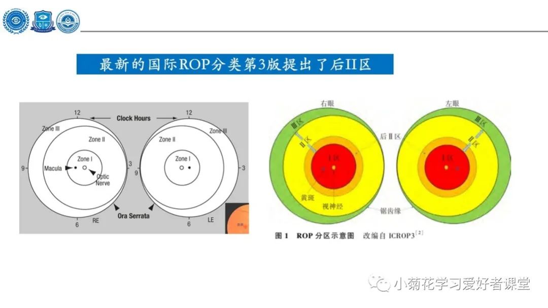 影像PPT - 【PPT】早产儿视网膜病变（ROP）-8