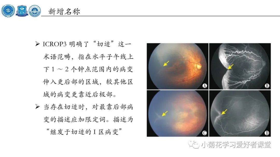 影像PPT - 【PPT】早产儿视网膜病变（ROP）-10