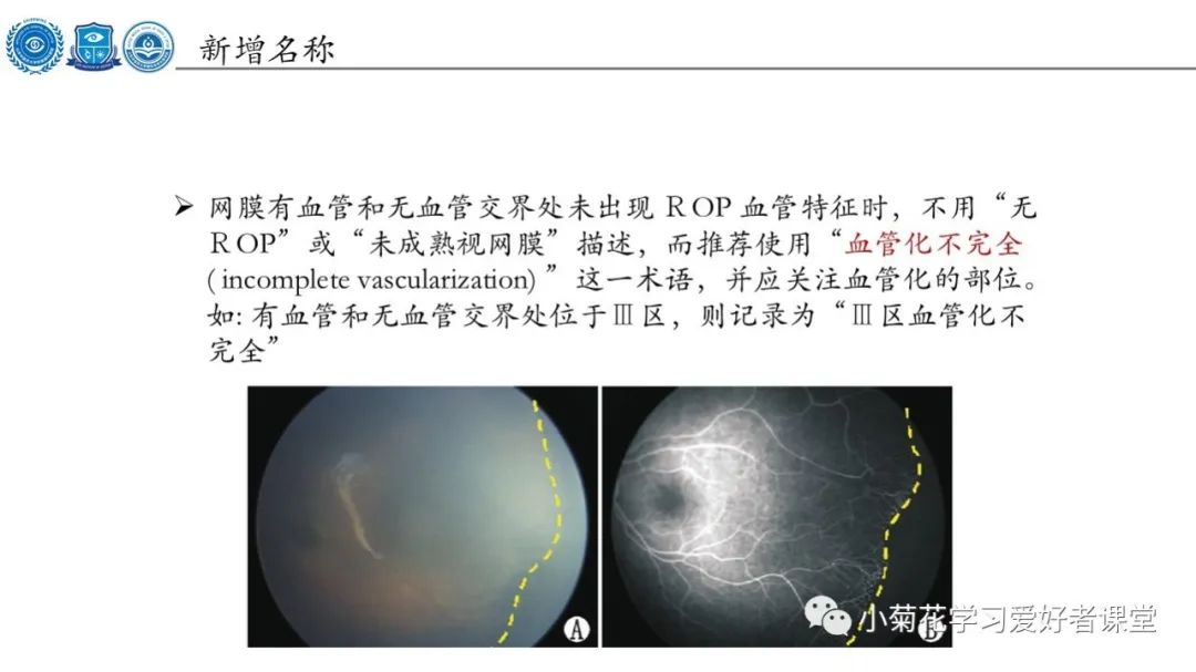 影像PPT - 【PPT】早产儿视网膜病变（ROP）-11