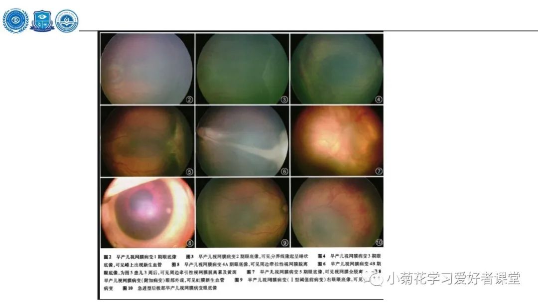 影像PPT - 【PPT】早产儿视网膜病变（ROP）-14