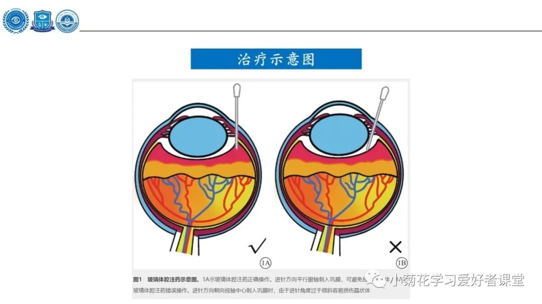 影像PPT - 【PPT】早产儿视网膜病变（ROP）-19