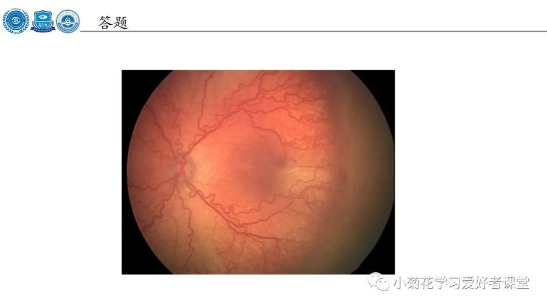 影像PPT - 【PPT】早产儿视网膜病变（ROP）-26