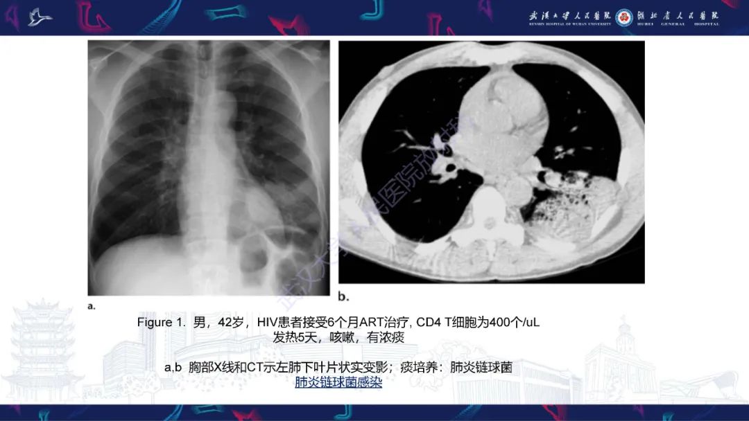 影像PPT - 【PPT】HIV/AIDS相关性胸部疾病影像诊断-5