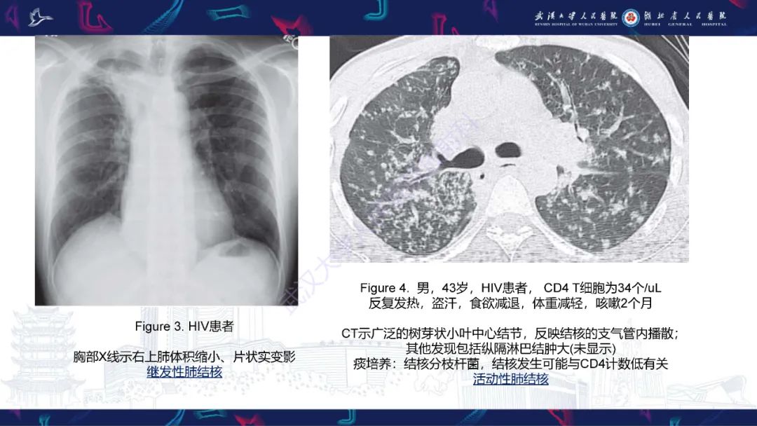 影像PPT - 【PPT】HIV/AIDS相关性胸部疾病影像诊断-8