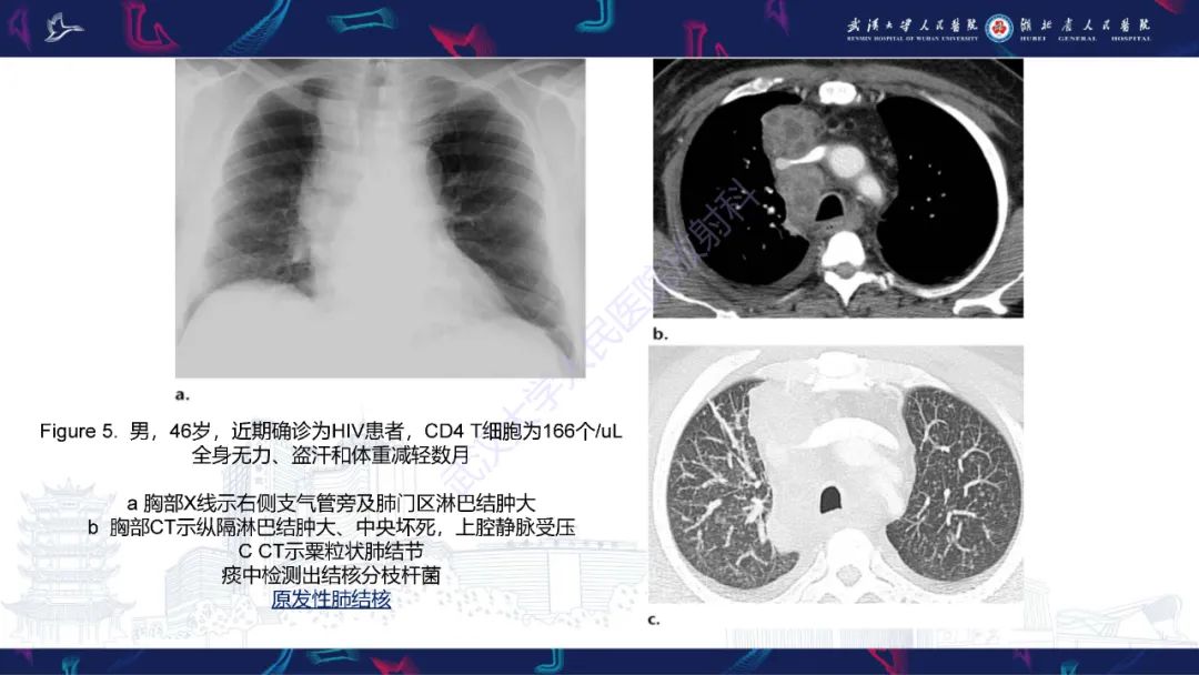 影像PPT - 【PPT】HIV/AIDS相关性胸部疾病影像诊断-9