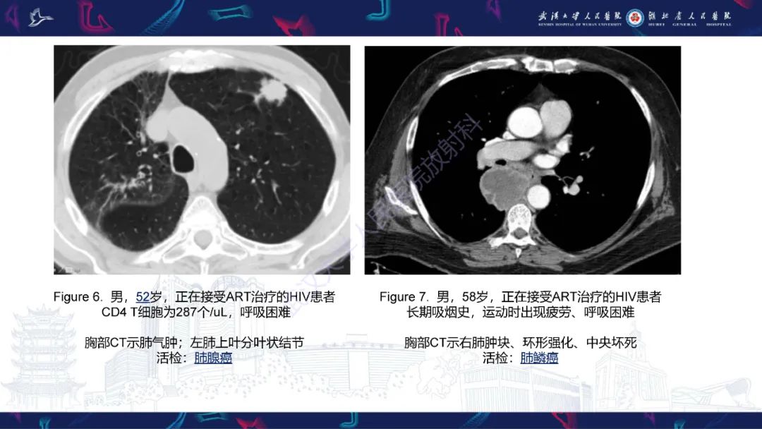 影像PPT - 【PPT】HIV/AIDS相关性胸部疾病影像诊断-11