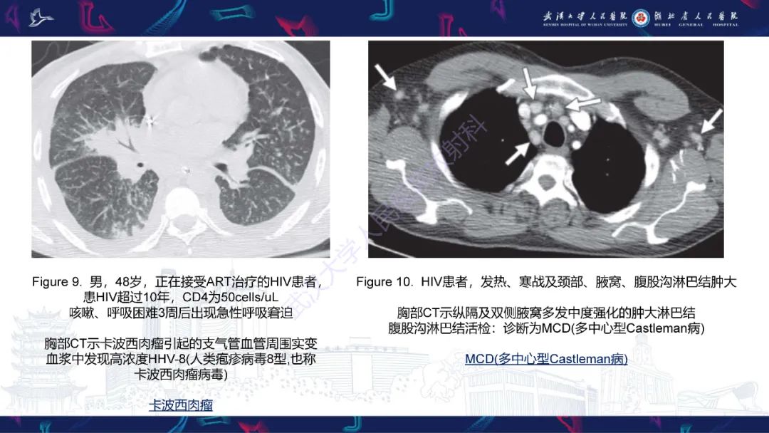 影像PPT - 【PPT】HIV/AIDS相关性胸部疾病影像诊断-14